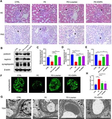 Empagliflozin Ameliorates Preeclampsia and Reduces Postpartum Susceptibility to Adriamycin in a Mouse Model Induced by Angiotensin Receptor Agonistic Autoantibodies